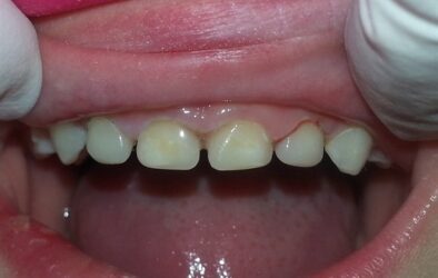Heroic Dentistry: Strip Crowns for Leigh