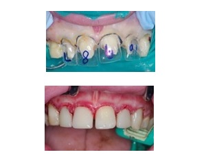 Read more about the article Heroic Dentistry: Severe Autism, Rampant Caries and Strip Crowns