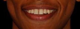 Yoseph's restored smile