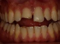 Read more about the article Heroic Dentistry: How Yoseph got his smile back