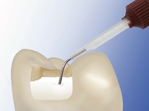 Read more about the article 5 More Ways to Use ACTIVA BioACTIVE-RESTORATIVE