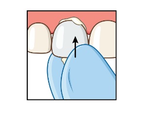 Read more about the article Strips Crowns in 5 Easy Steps