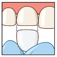 Strip Crown Figure 3