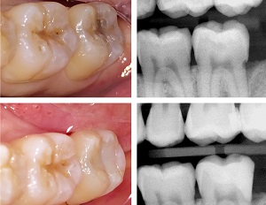 Read more about the article Heroic Dentistry: The Open Sandwich Technique