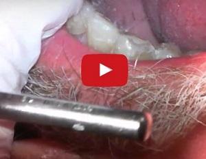 Read more about the article Full Mouth Rehab with ACTIVA BioACTIVE by Dr. Cory Glenn