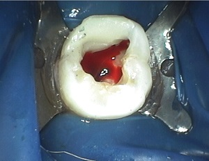 Read more about the article Heroic Dentistry: Asperger’s Syndrome and Special Care with ACTIVA
