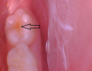 Direct from the Operatory: Embrace Pit & Fissure Sealant