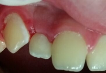 Direct from the Operatory: Bulk Filling with ACTIVA BioACTIVE-RESTORATIVE