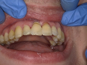 Read more about the article Heroic Dentistry: Trauma, External Resorption, Extraction, and Splinting the Natural Crown with ACTIVA