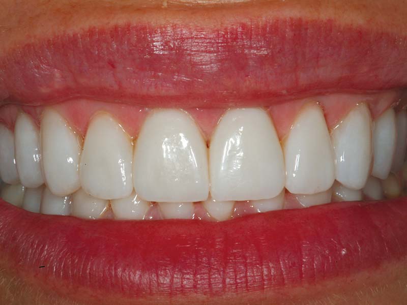 clinical-procedure1-kleer-veneer-5