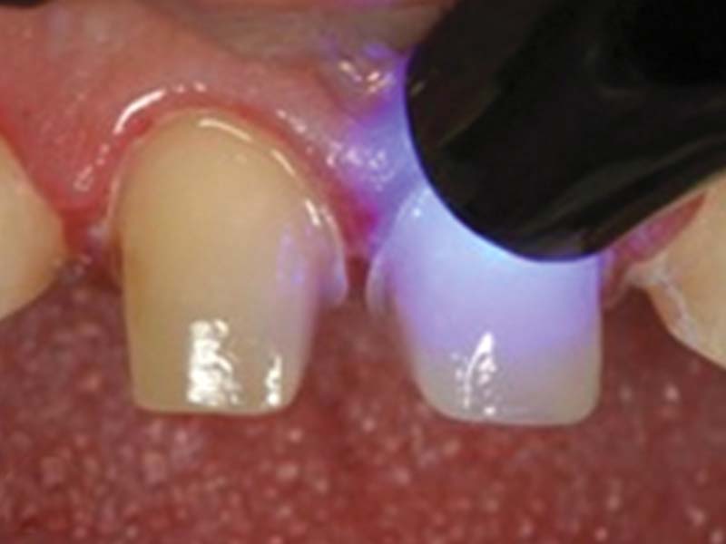 clinical-procedure2-kleer-veneer-4