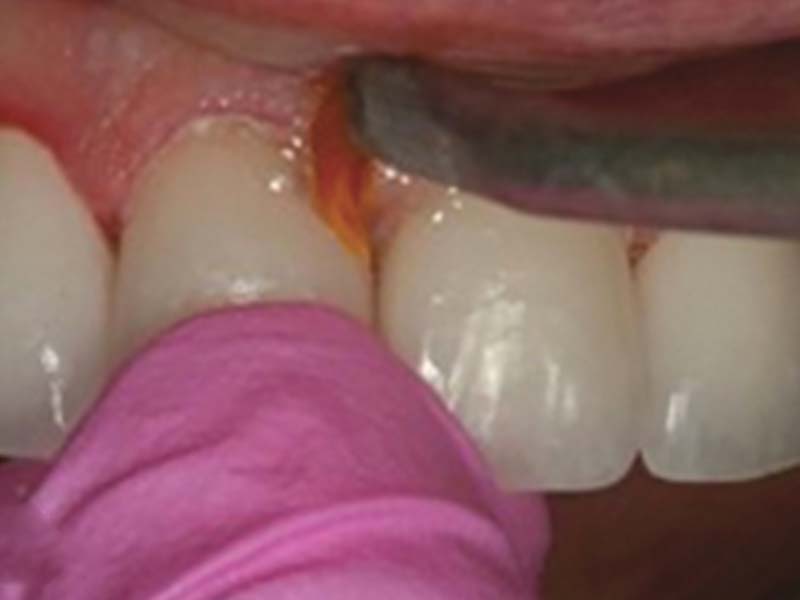 clinical-procedure2-kleer-veneer-5