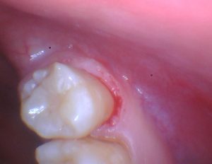 Read more about the article Direct from the Operatory: Bioactive Restoration of Decayed Wisdom Tooth