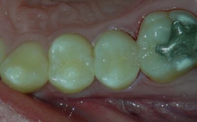 Direct from the Operatory: Minimally Invasive Bioactive Restorations