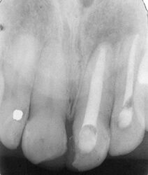 Successful Treatment of Long-standing Periapical Lesion