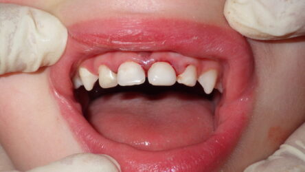 Direct From The Operatory: Strip Crowns and ACTIVA KIDS