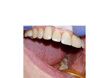 Read more about the article Heroic Dentistry: Reusing a Broken Crown