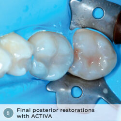 Heroic Dentistry: Quick, Effective, One-visit, Multiple-unit ACTIVA Restorations