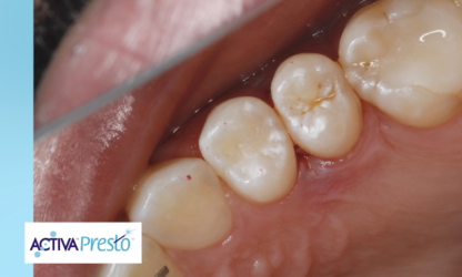 NEW VIDEO! Dr. Joshua Austin x Dental Economics present ACTIVA Presto