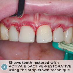 Heroic Dentistry: Severe Autism, Rampant Caries, Strip Crowns and ACTIVA BioACTIVE-RESTORATIVE
