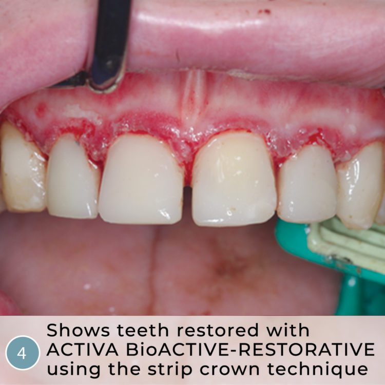 Read more about the article Heroic Dentistry: Severe Autism, Rampant Caries, Strip Crowns and ACTIVA BioACTIVE-RESTORATIVE