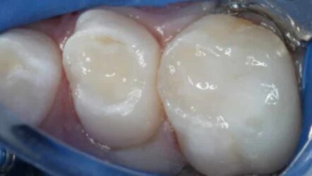 Bioactive restorations in pediatric dentistry