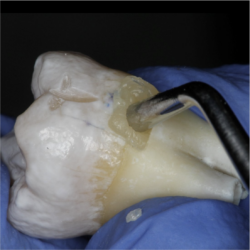 Activa BioActive-Restorative: A Study on its Protective Effect Against Demineralization