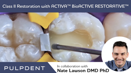 Class II Restoration with ACTIVA™ BioACTIVE-RESTORATIVE™