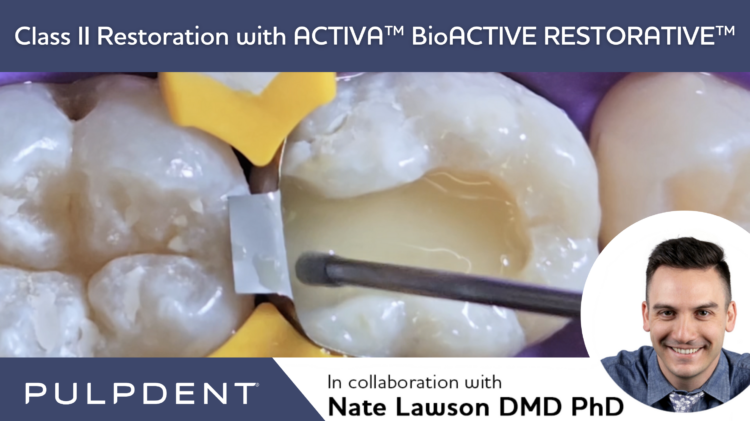 Read more about the article Class II Restoration with ACTIVA™ BioACTIVE-RESTORATIVE™